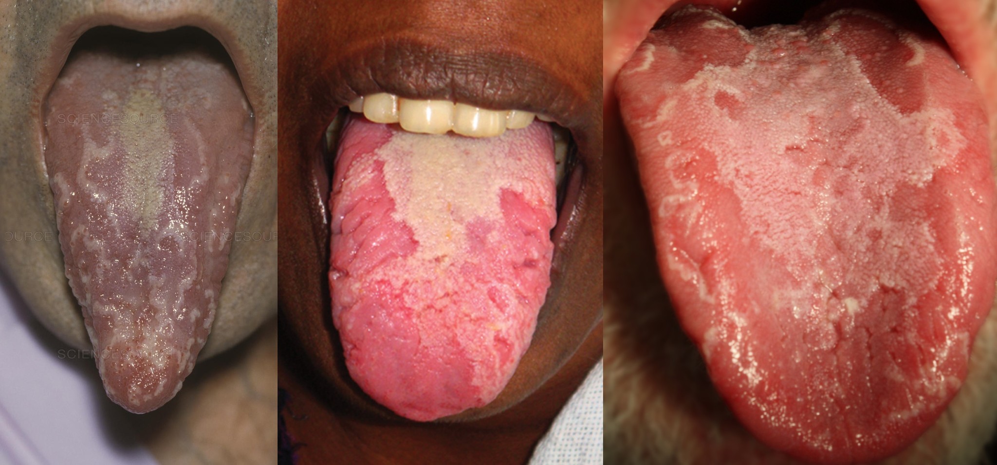Глоссит или воспаление языка у взрослых: виды, симптомы, лечение