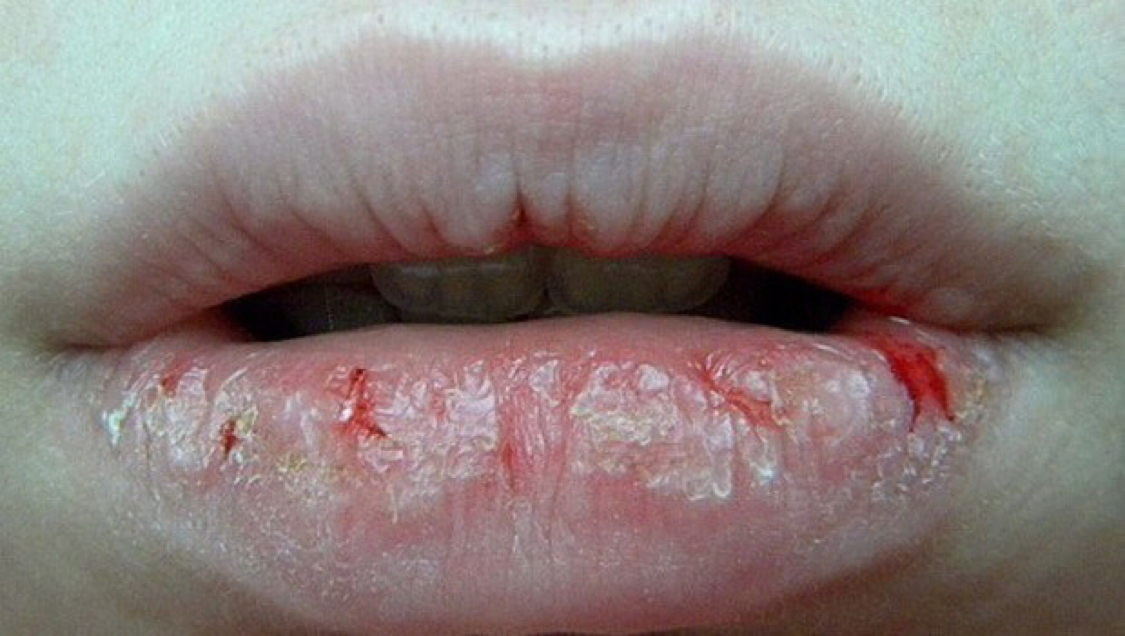 How to stop eating lips - My, Bad habits, Lips, Treatment, Bepanten, Appetite