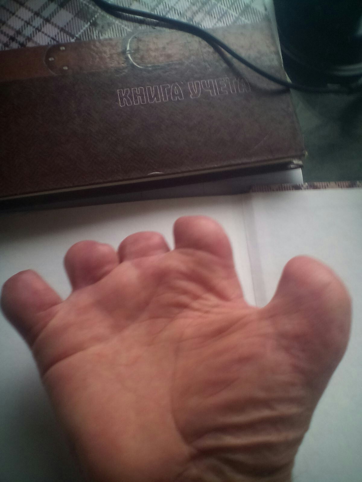 ампутированный палец фото
