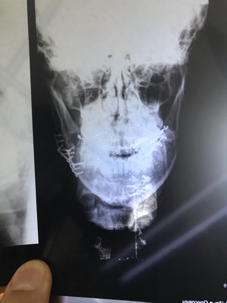 Bilateral fracture of the lower jaw with displacement of fragments - Jaw fracture, Fracture of the lower jaw, Traumatology