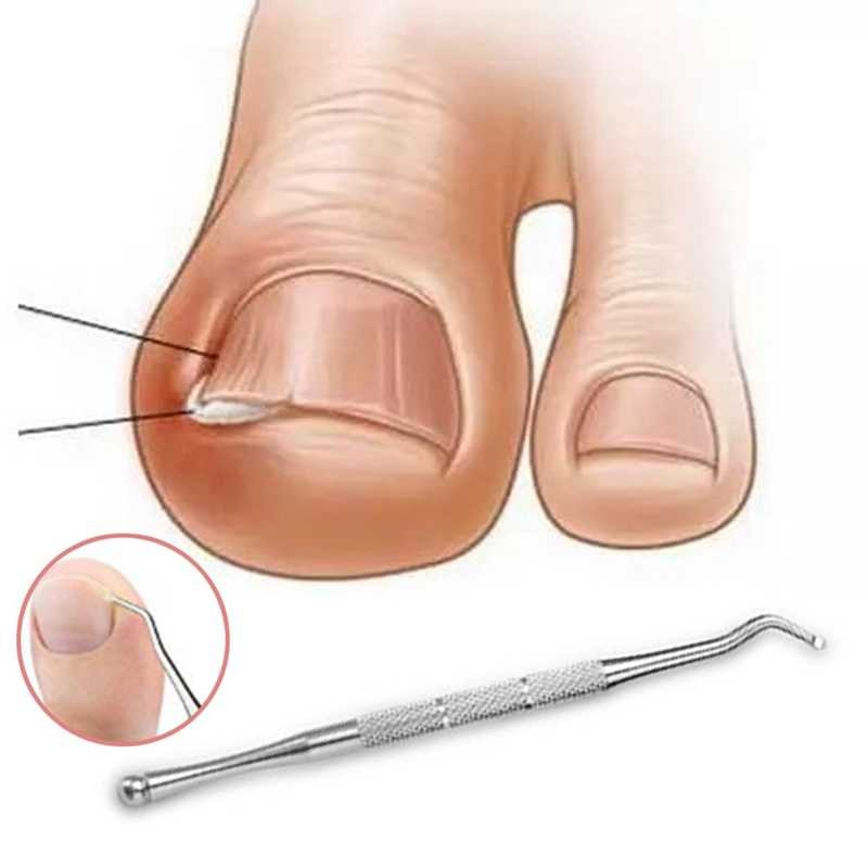 Паронихия пальца: лечение консервативными методами и хирургическое — клиника «Добробут»
