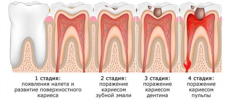 Стоматология - Моё, Стоматология, Пульпит, Кариес, Периодонтит, Флюс, Киста, Пародонтит, Пародонтоз, Длиннопост