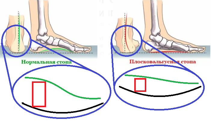 Патология стопы для всех - Травматология, Медицина, Стопы, Длиннопост