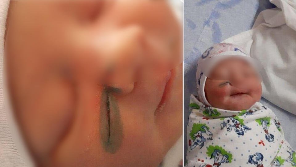 A newborn girl received a cut on her cheek during a caesarean section Just a cry from the heart - Injustice, Doctors, Public, The medicine, Accident, Lawlessness, Kyshtym, No rating