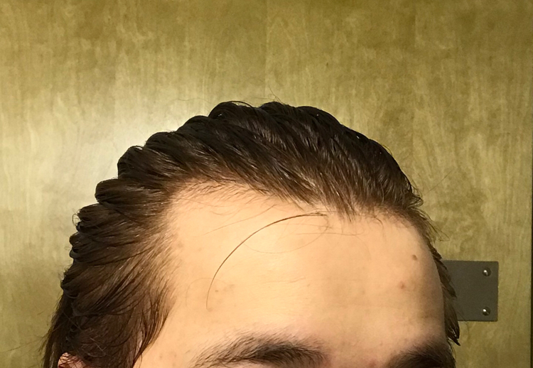 Are there any trichologists here?) - My, Hair, Forehead, Bald head