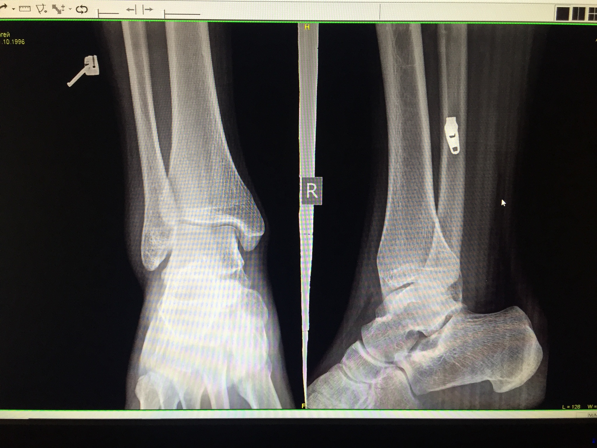 Мой первый перелом ноги, да детка( 5 плюсневая кость без смещения, в ...