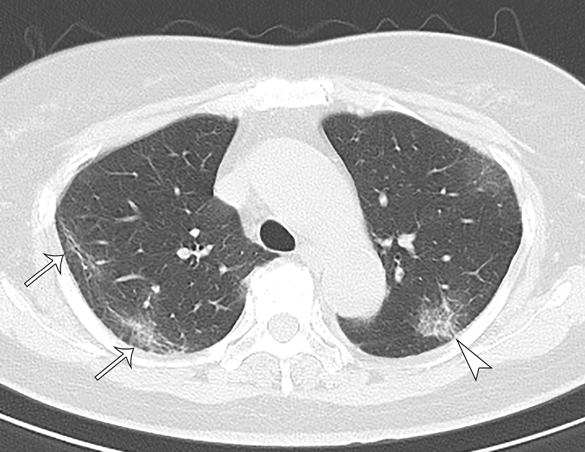 Lung lesions found in asymptomatic COVID-19 patients - Coronavirus, Lungs, Health, Consequences, Research, The medicine, CT, Information, Longpost