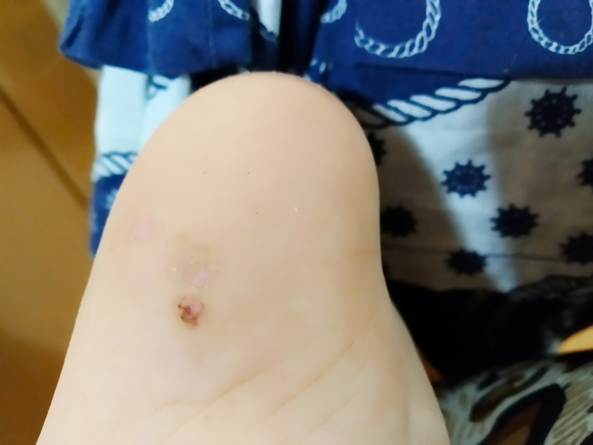 Plantar wart: a brief history of the creation and collapse of an empire - My, Warts, Self-medication, Longpost