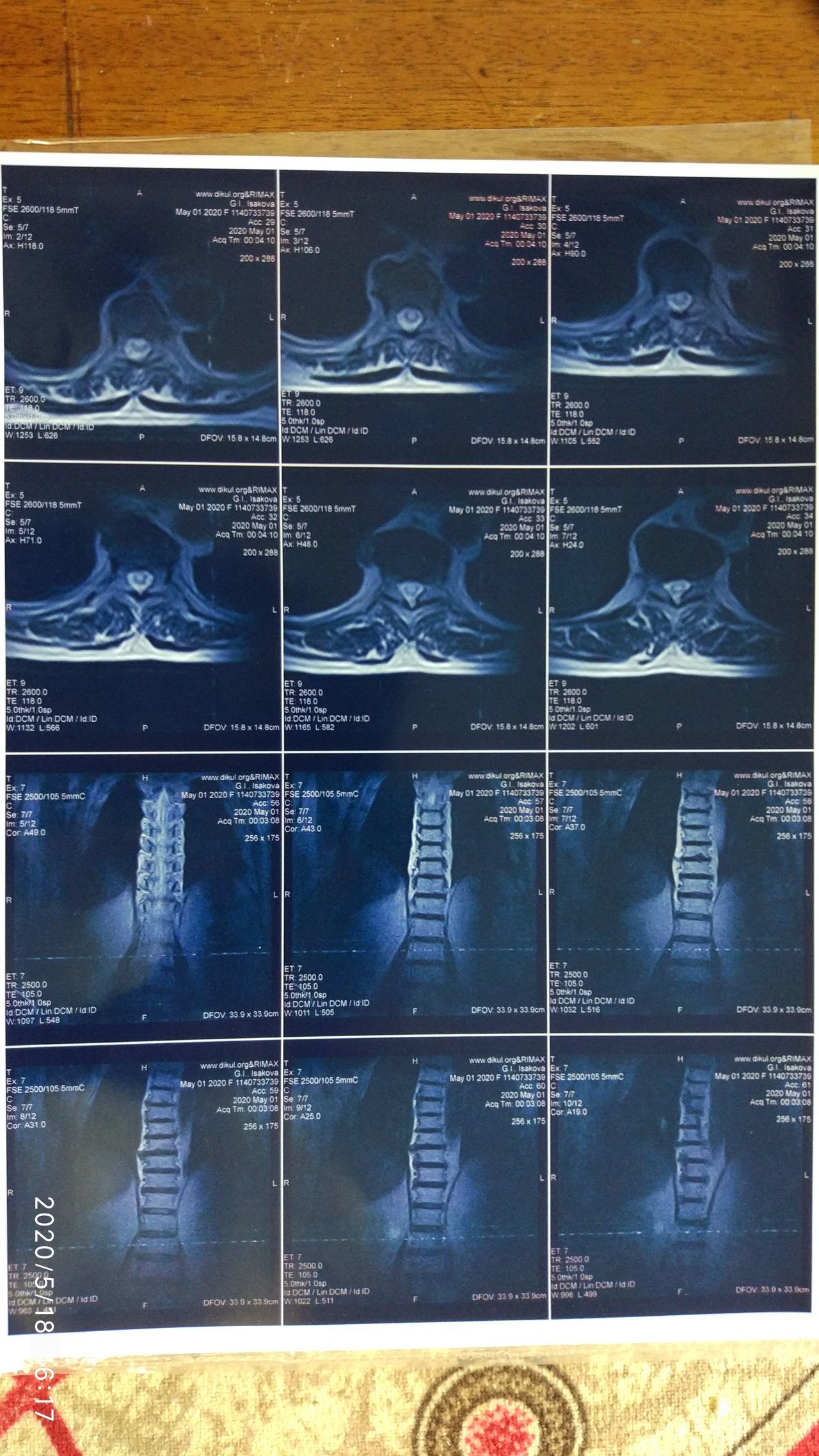 Need help from a neurologist or oncologist - MRI, Legs, Disease, Longpost