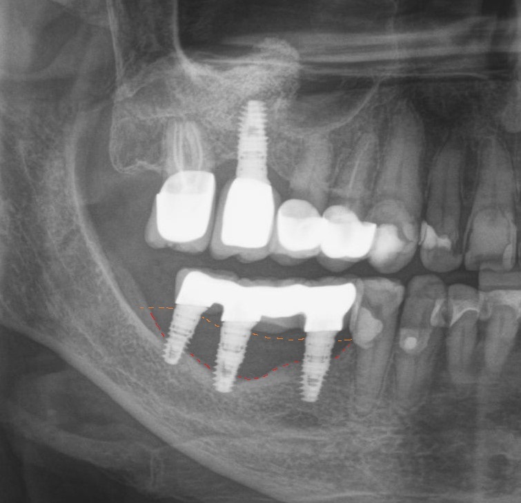 Dentistry: expectation and reality - My, Dentist, Dentistry, Surgeon, Doctors, Teeth, Dental implantation, The medicine, Doctor, Longpost