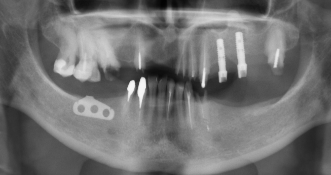 Total prosthetics on implants - My, Dentist, Dentistry, Implantation, Dental implantation, Extraction of teeth, Teeth, Doctors, Longpost