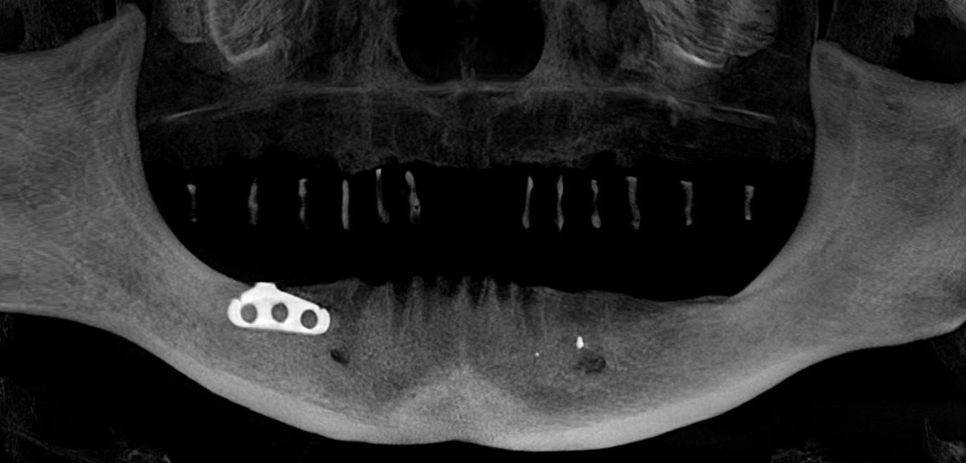 Total prosthetics on implants - My, Dentist, Dentistry, Implantation, Dental implantation, Extraction of teeth, Teeth, Doctors, Longpost