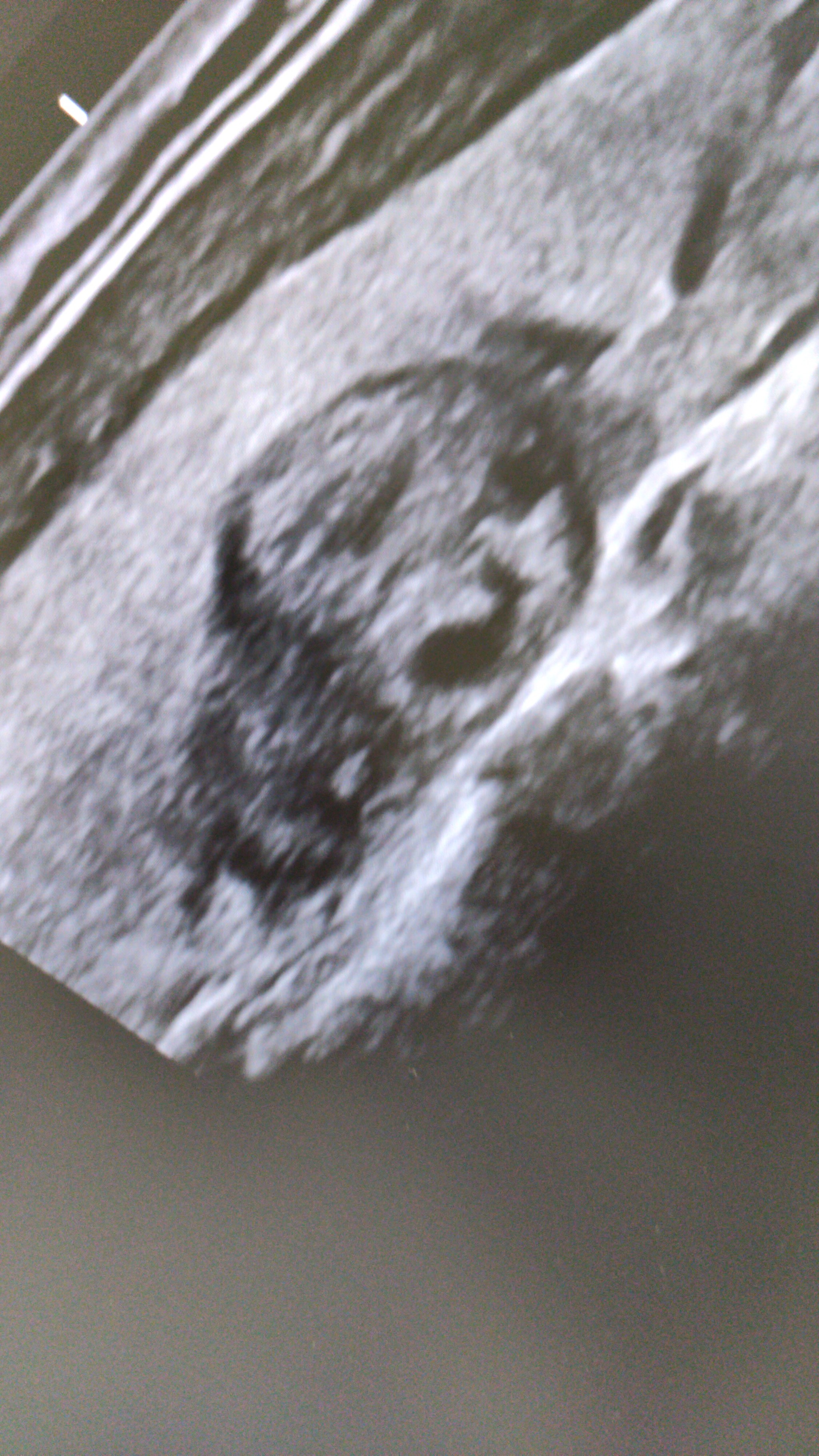 Sudden pareidolia on ultrasound - Ultrasound, Pareidolia, It seemed, The medicine