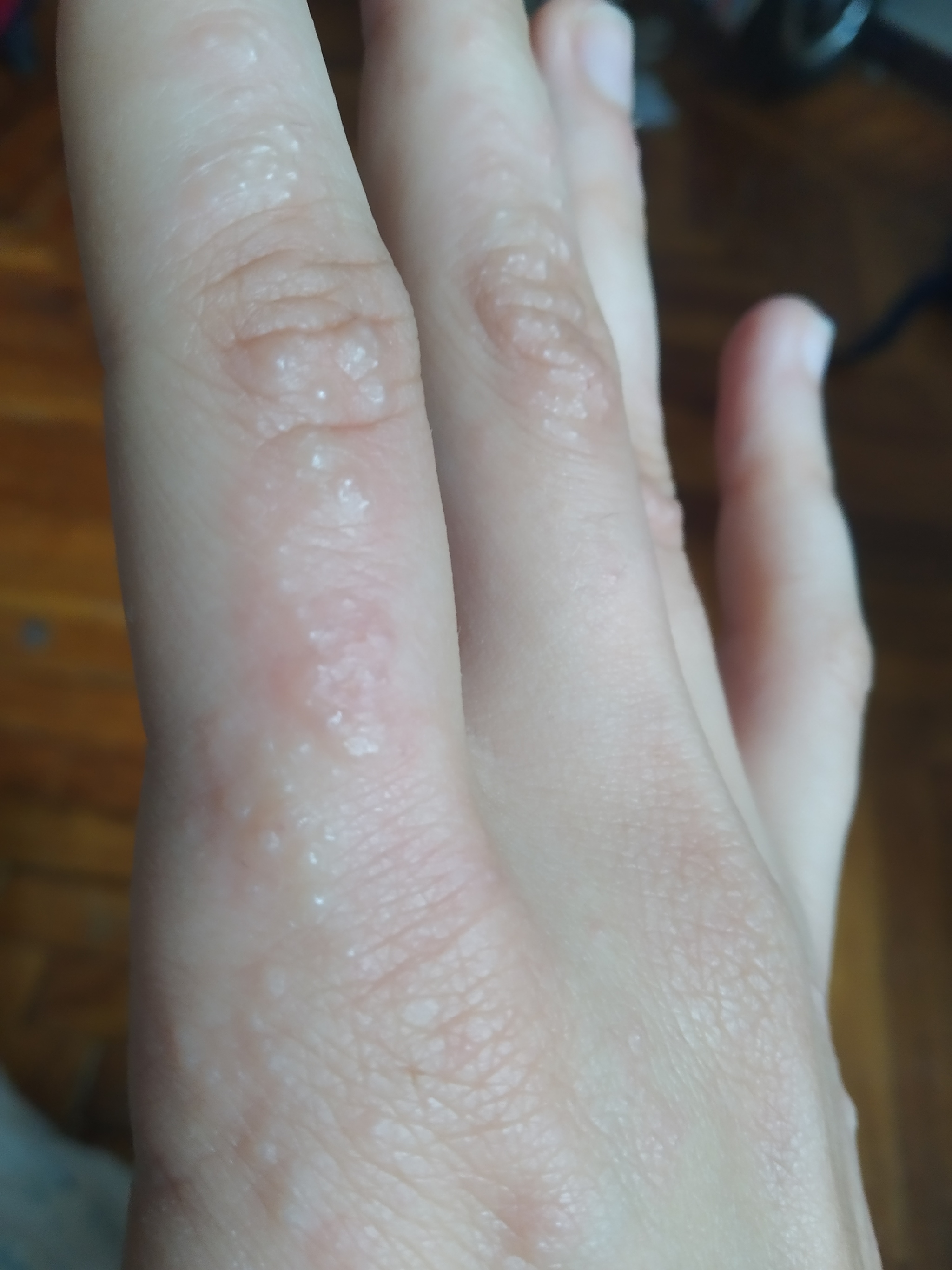 Аллергия | Пикабу