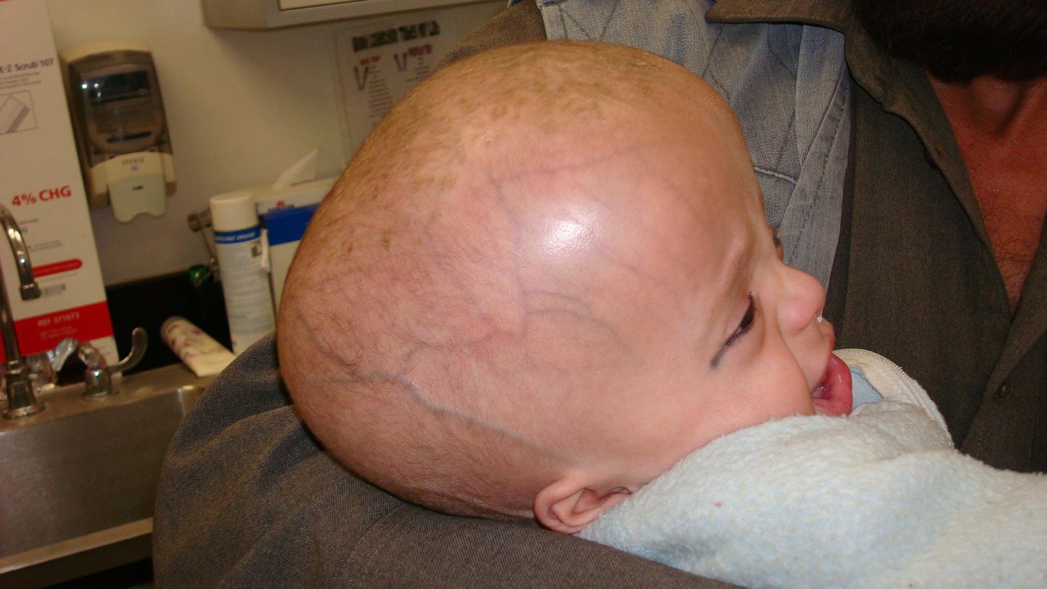 The first experience of intrauterine correction of hydrocephalus