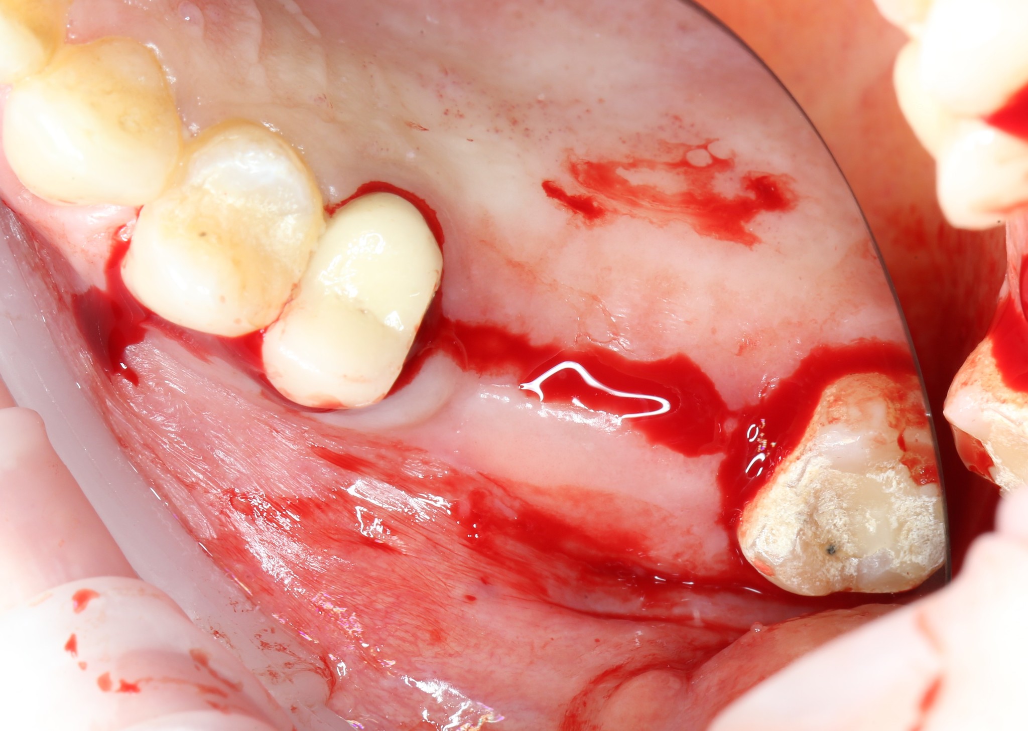 Sinus lift: how is it done? Part I - My, Dentist, Dentistry, Surgery, Implantation, Dental implantation, The medicine, Extraction of teeth, Doctors, Teeth, Doctor, Longpost, Informative