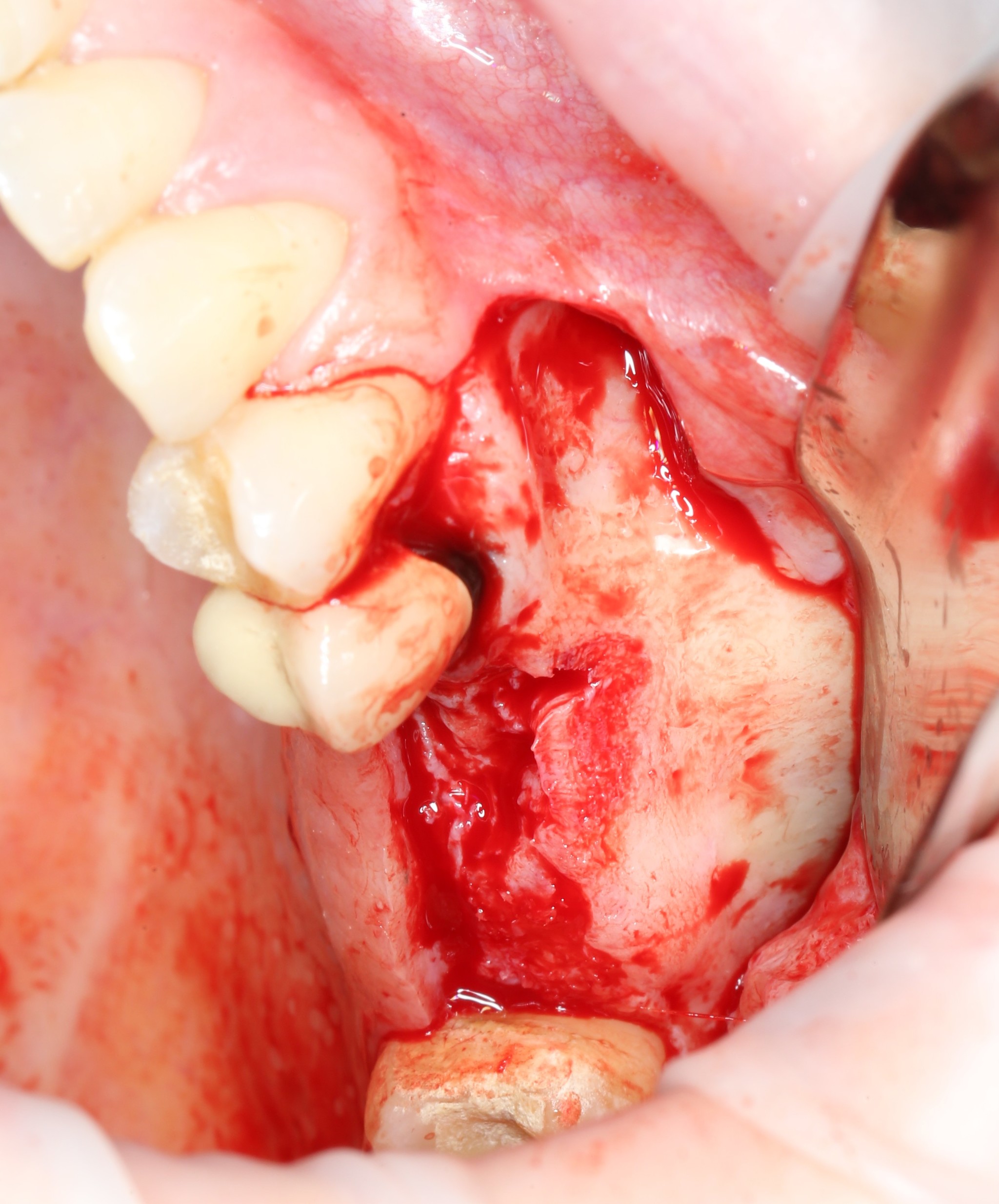 Sinus lift: how is it done? Part I - My, Dentist, Dentistry, Surgery, Implantation, Dental implantation, The medicine, Extraction of teeth, Doctors, Teeth, Doctor, Longpost, Informative