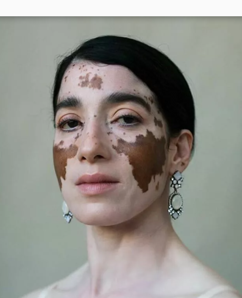 Vitiligo - My, Nature, beauty, Longpost