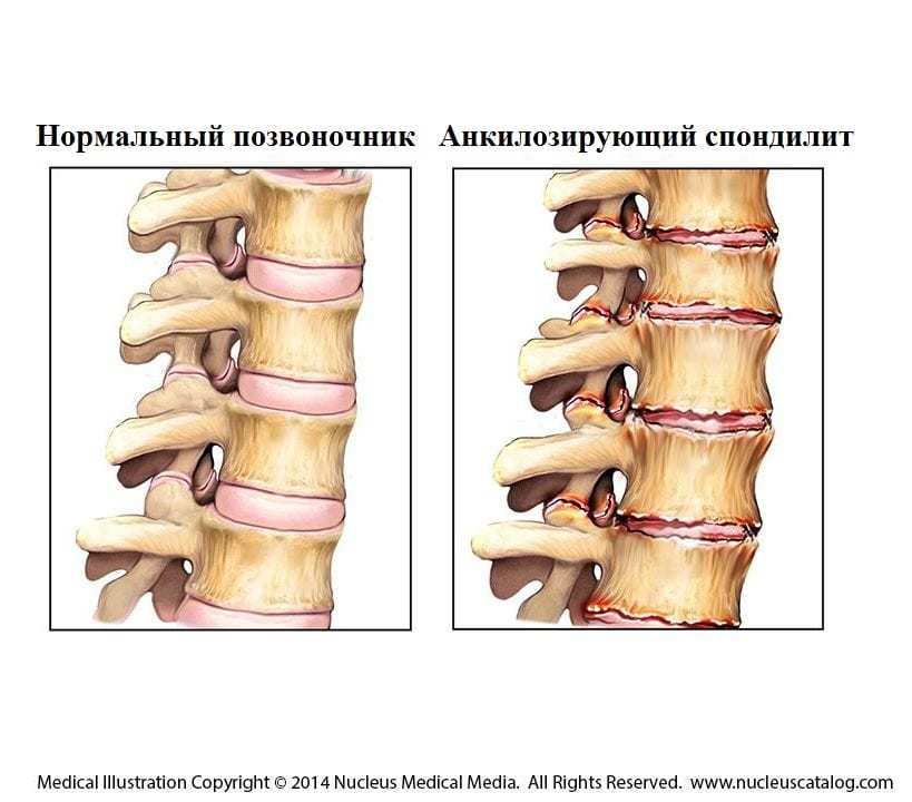 Bamboo spine disease or ankylosing spondylitis + clinical case with MRI images - My, Neurology, The medicine, Health, Rheumatology, Bechterew's disease, Blog, Longpost