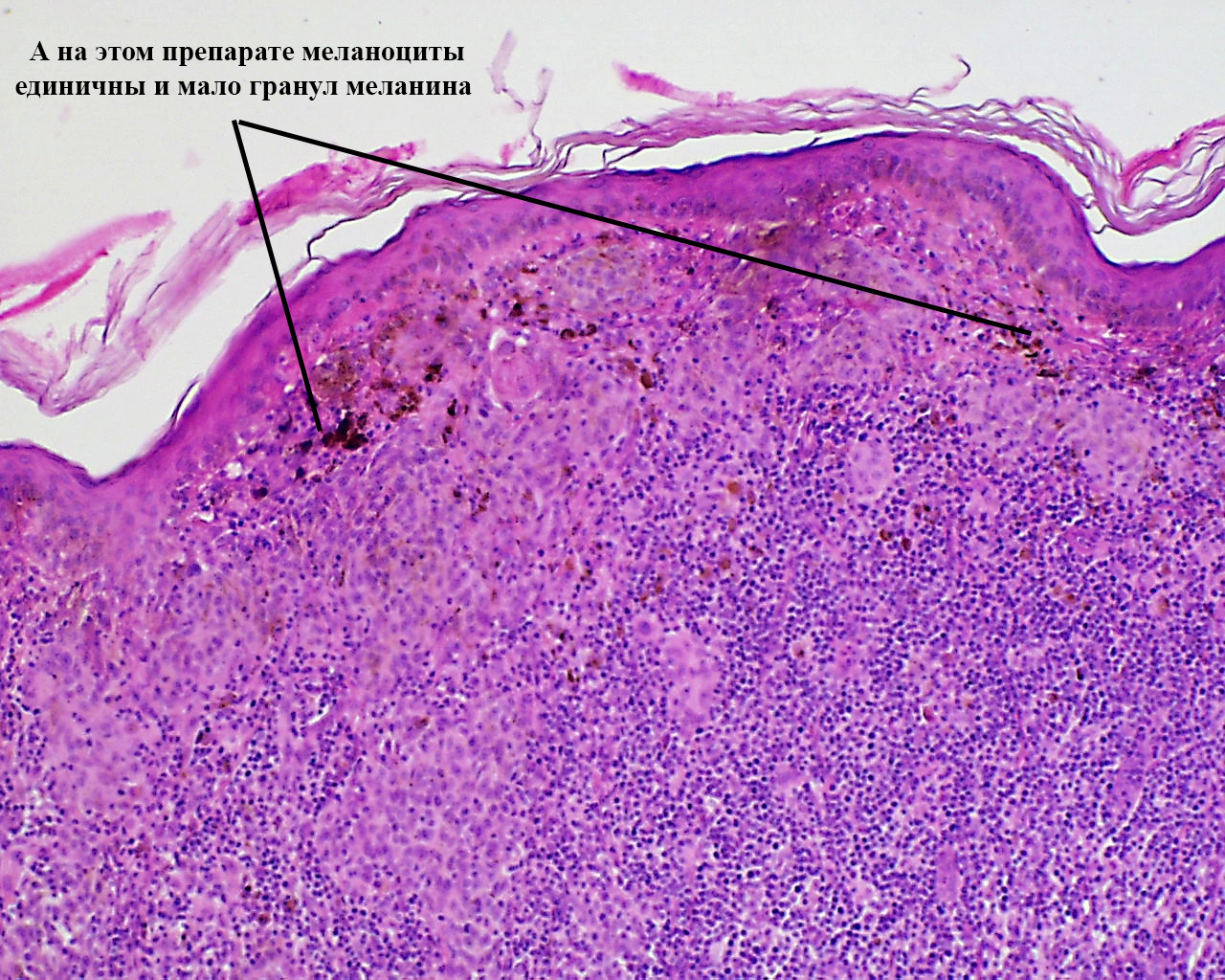 What is vitiligo? + skin under a microscope - My, The medicine, Disease, Vitiligo, Histology, Longpost, Pigmentation