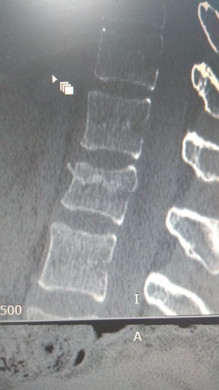 Compression fracture of the spine l1 - need help and advice 2 - My, Fracture of the spine, Neurosurgery, Injury, Traumatology, Loin, Hospital, Longpost