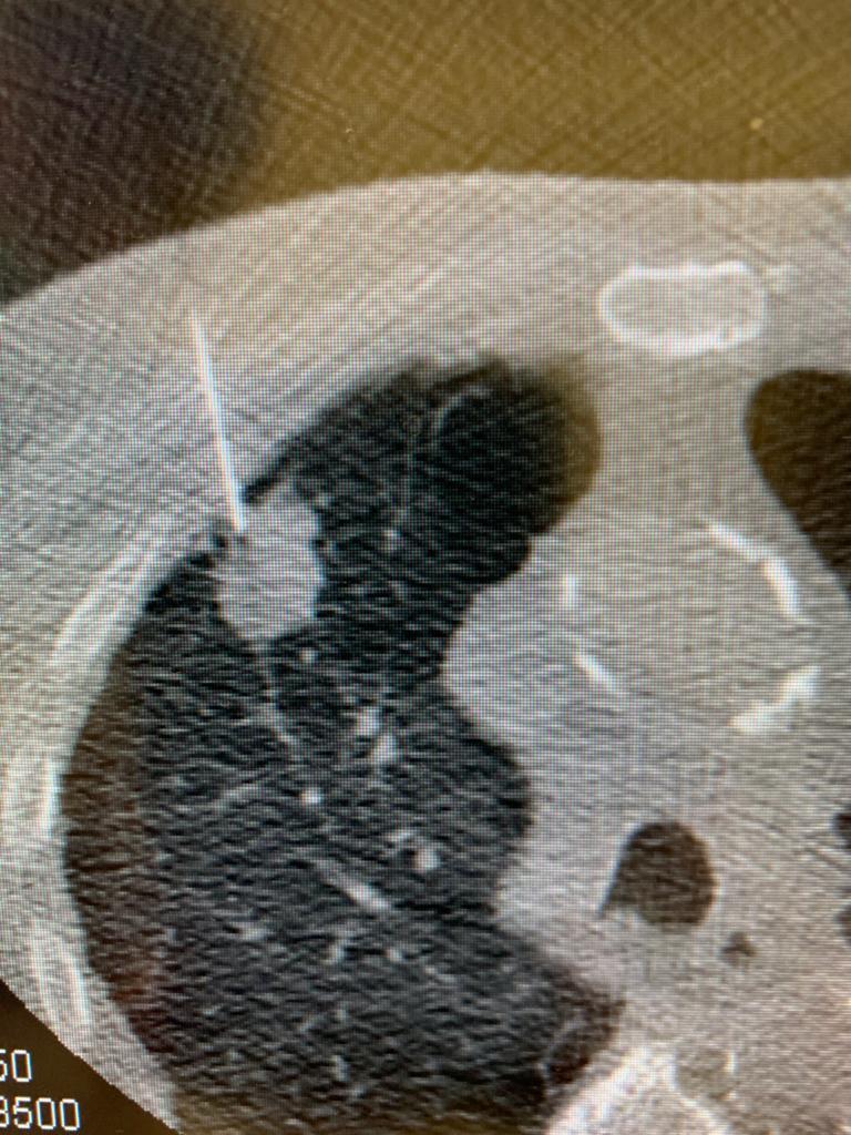 Puncture surgery or thoracoscopy in thoracic oncology - My, Cancer and oncology, Surgery, Longpost, GIF, The medicine