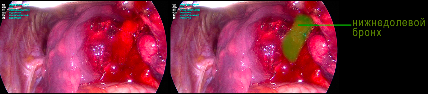 Puncture surgery or thoracoscopy in thoracic oncology - My, Cancer and oncology, Surgery, Longpost, GIF, The medicine