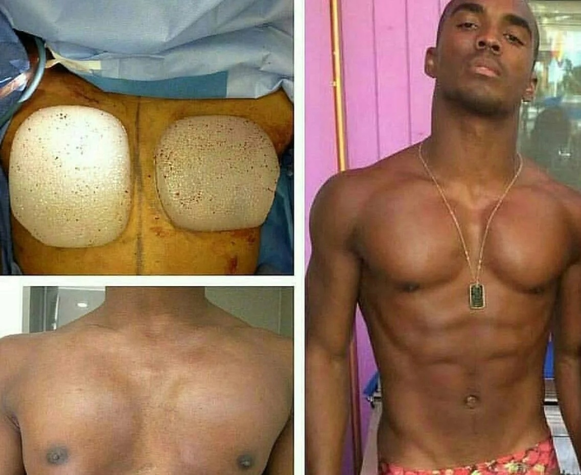 имплант в груди у мужчин фото 4