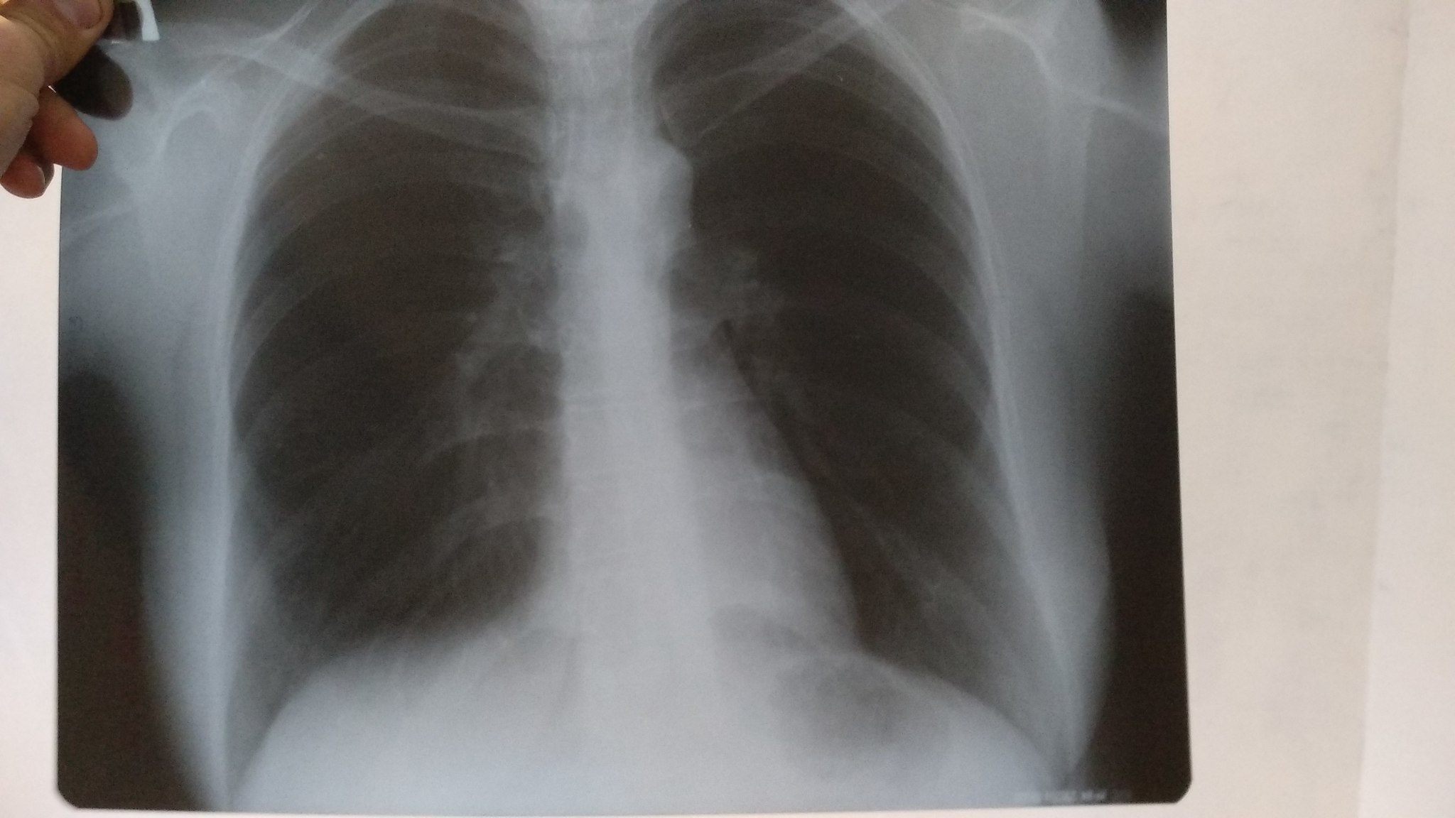 Description of X-ray - No rating, X-ray, Pneumonia