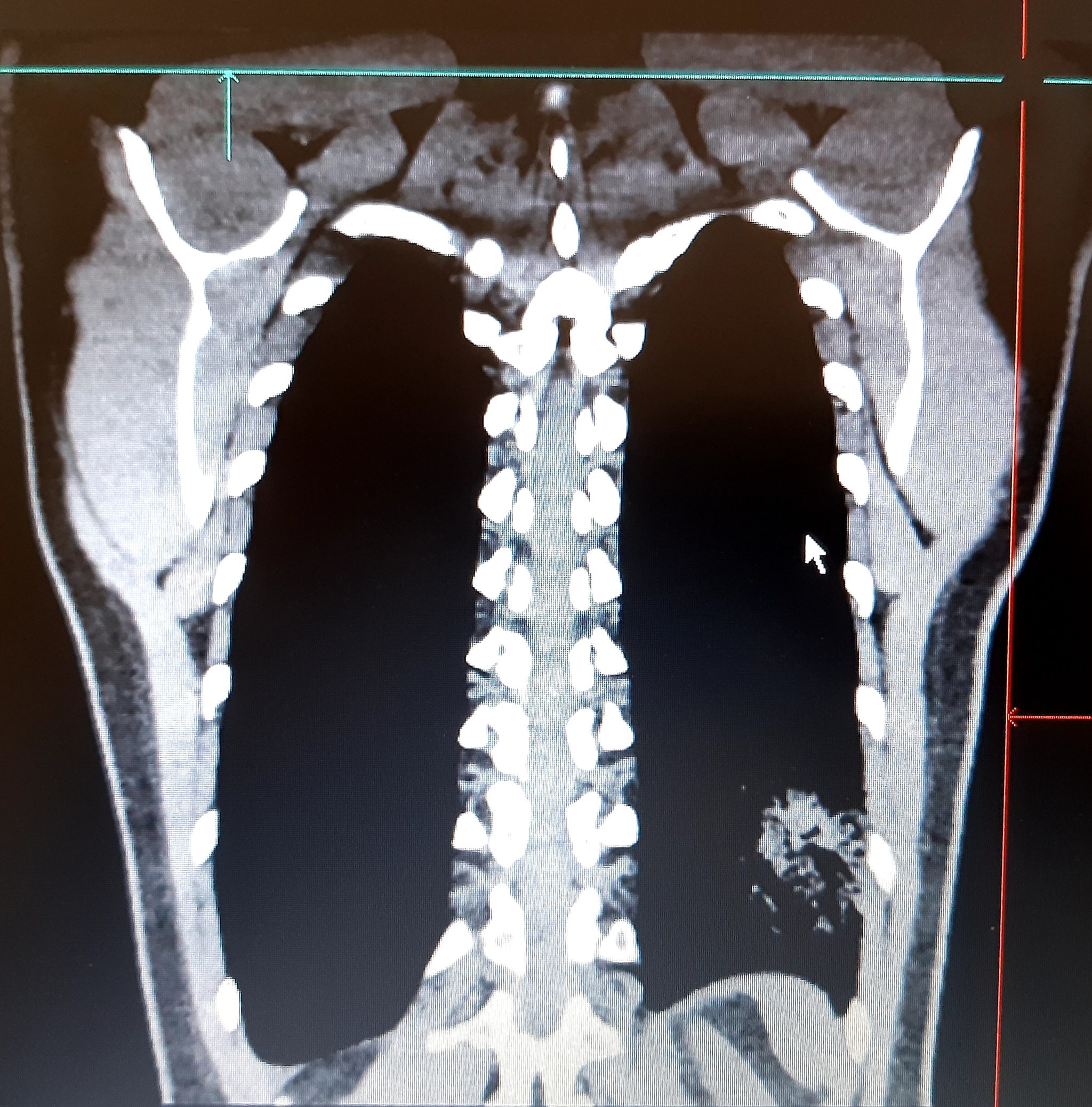 Viral pneumonia on CT - Pneumonia, The medicine, Shock, Coronavirus