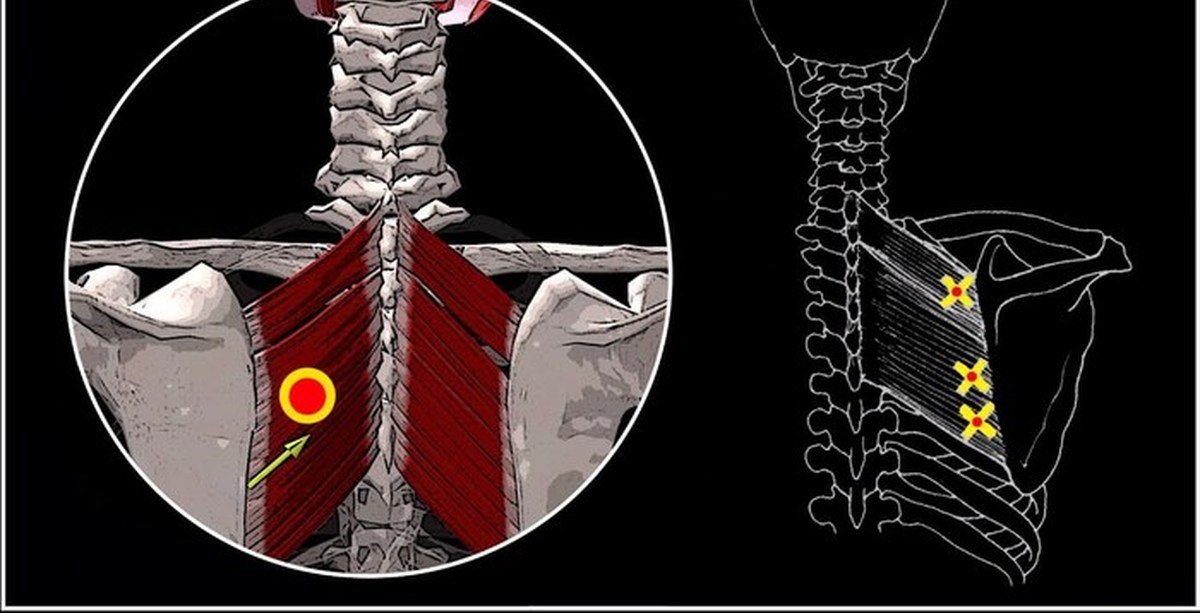 Ромбовидная мышца спины триггерные точки. Триггерные точки ромбовидной мышцы. Триггерные точки между лопатками. Малая ромбовидная мышца триггерные точки.
